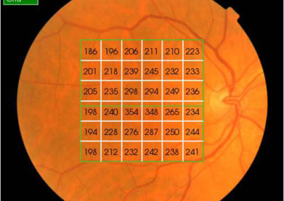 Age Related Macular Degeneration