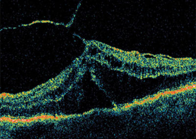 Retinal Detachment seen through OCT Eye Scan