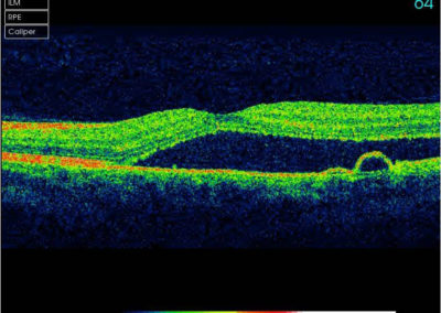 Wet AMD seen through OCT Eye Scan