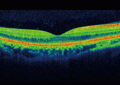 3D OCT Eye Scan